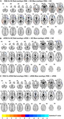 Alterations of brain activity in multiple system atrophy patients with freezing of gait: A resting-state fMRI study